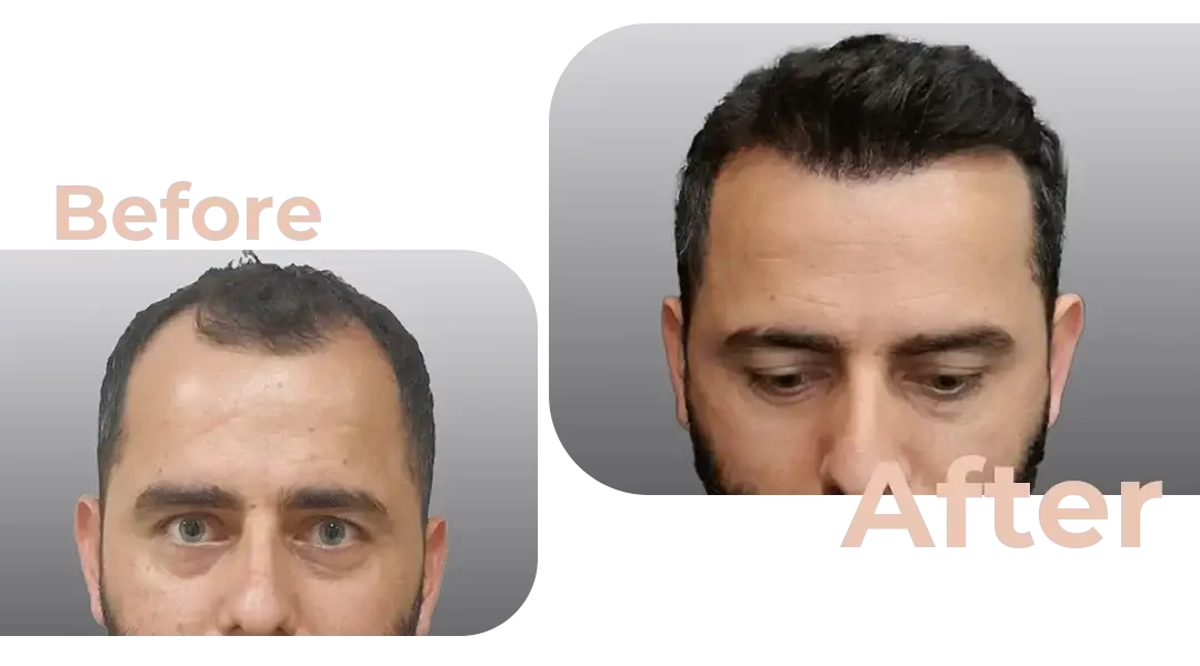 FUE Hair Transplant in Istanbul, Turkey by Avicenna Hospital