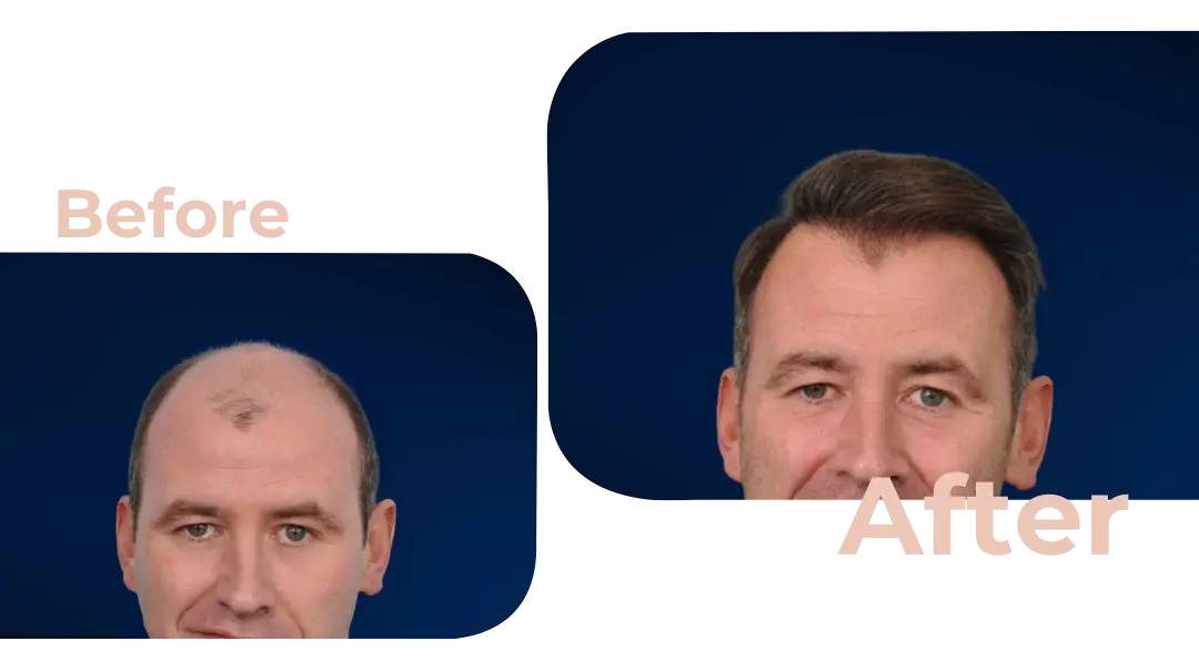 FUE Hair Transplant in Istanbul, Turkey by Avicenna Hospital