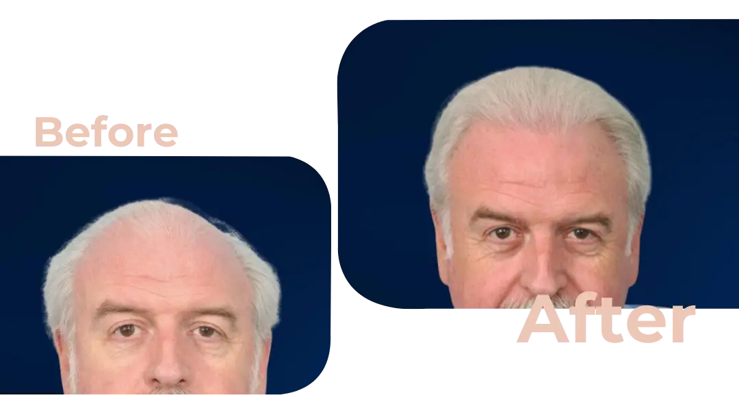 FUE Hair Transplant in Istanbul, Turkey by Avicenna Hospital