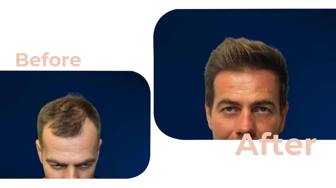 FUE Hair Transplant in Istanbul, Turkey by Avicenna Hospital