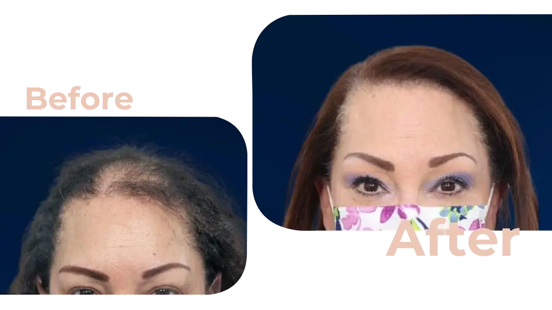 FUE Hair Transplant in Istanbul, Turkey by Avicenna Hospital