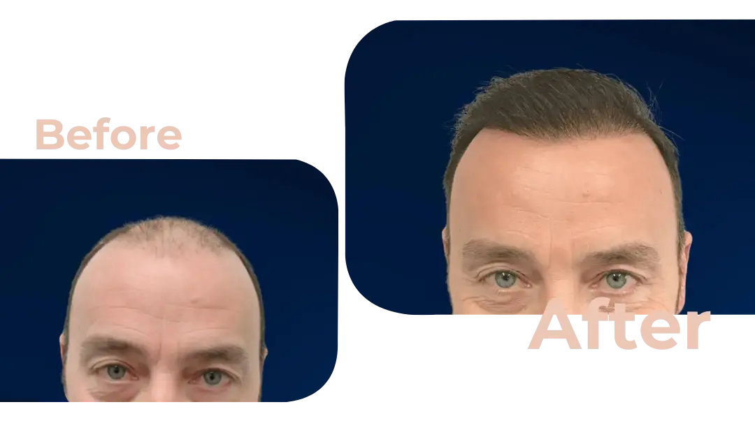 FUE Hair Transplant in Istanbul, Turkey by Avicenna Hospital