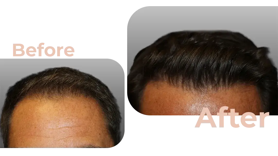 FUE Hair Transplant in Istanbul, Turkey by Avicenna Hospital