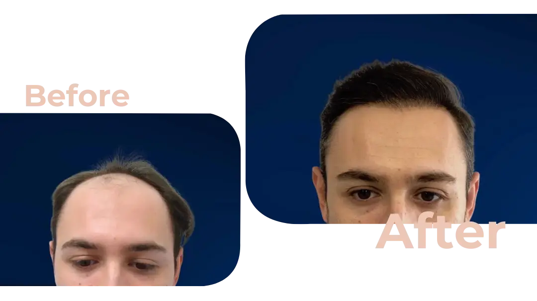 FUE Hair Transplant in Istanbul, Turkey by Avicenna Hospital