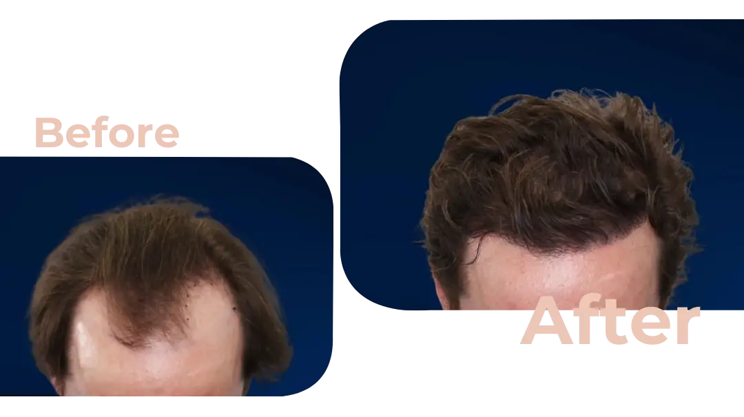 FUE Hair Transplant in Istanbul, Turkey by Avicenna Hospital