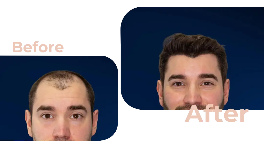 FUE Hair Transplant in Istanbul, Turkey by Avicenna Hospital