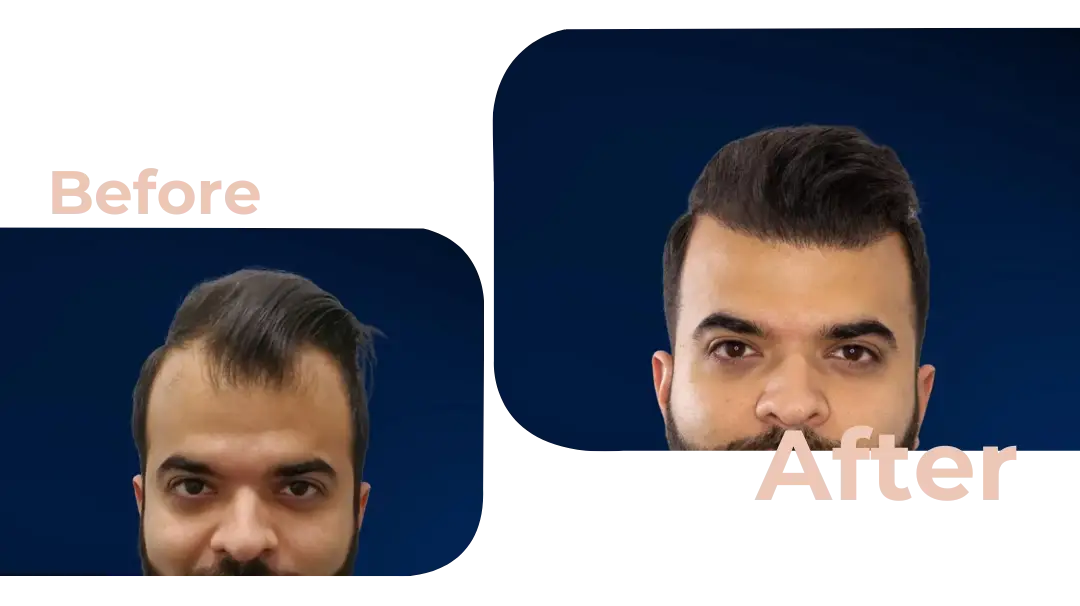 FUE Hair Transplant in Istanbul, Turkey by Avicenna Hospital