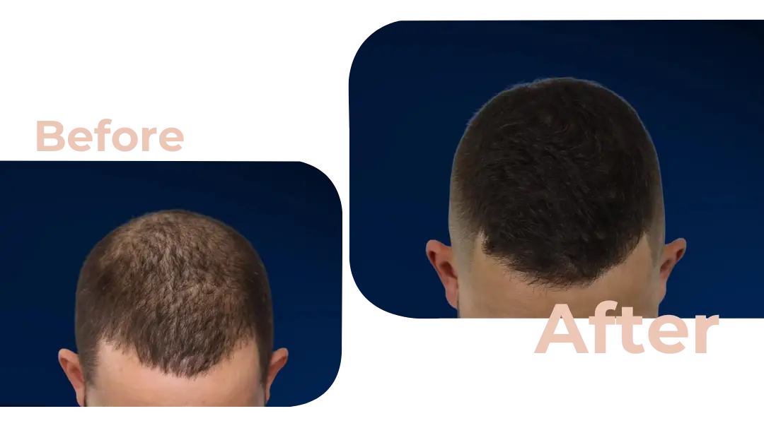 FUE Hair Transplant in Istanbul, Turkey by Avicenna Hospital
