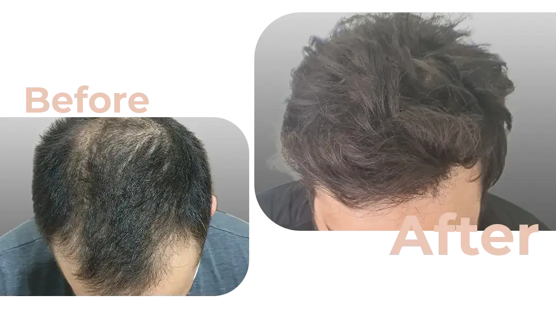 FUE Hair Transplant in Istanbul, Turkey by Avicenna Hospital