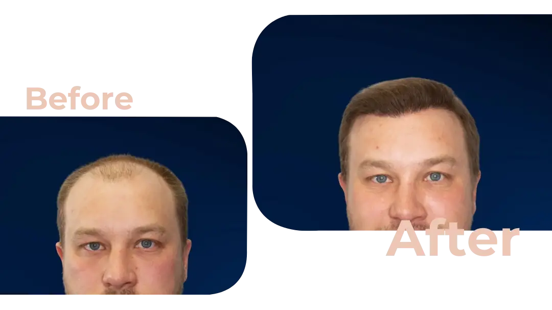 FUE Hair Transplant in Istanbul, Turkey by Avicenna Hospital