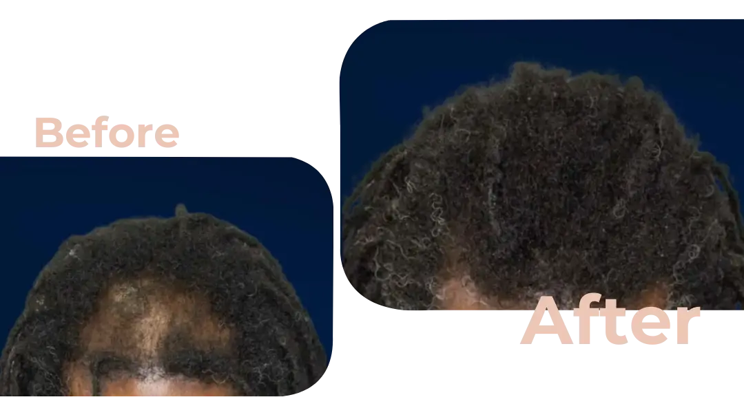 FUE Hair Transplant in Istanbul, Turkey by Avicenna Hospital