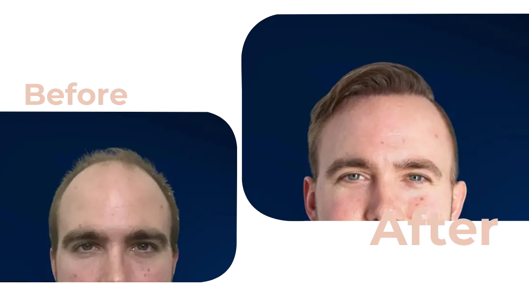 FUE Hair Transplant in Istanbul, Turkey by Avicenna Hospital