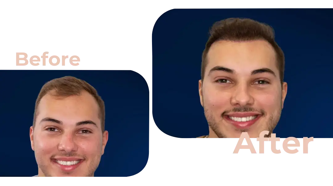 FUE Hair Transplant in Istanbul, Turkey by Avicenna Hospital