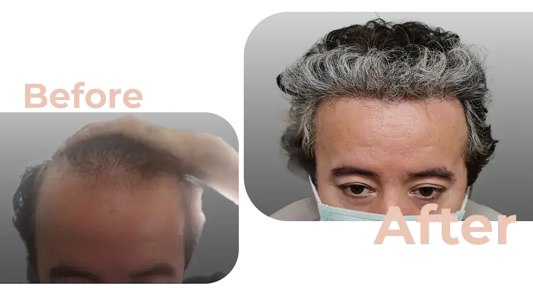 FUE Hair Transplant in Istanbul, Turkey by Avicenna Hospital