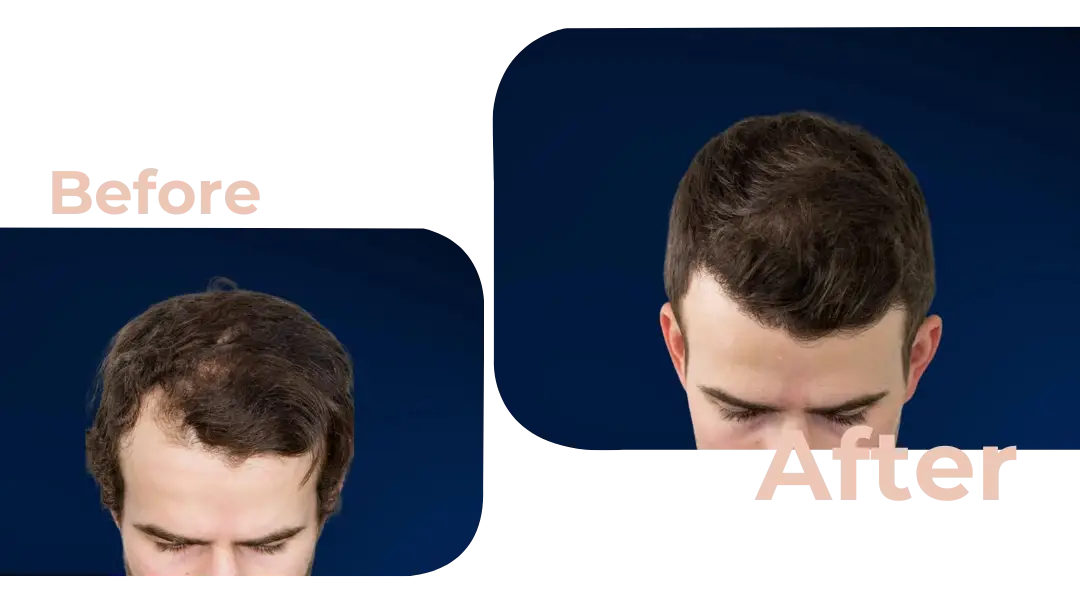 FUE Hair Transplant in Istanbul, Turkey by Avicenna Hospital