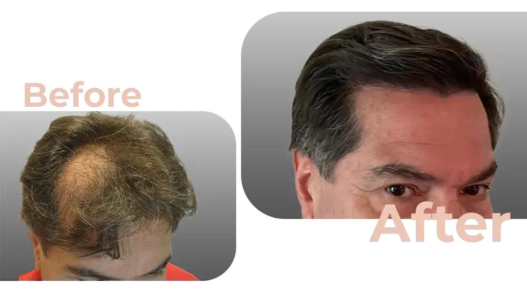 FUE Hair Transplant in Istanbul, Turkey by Avicenna Hospital