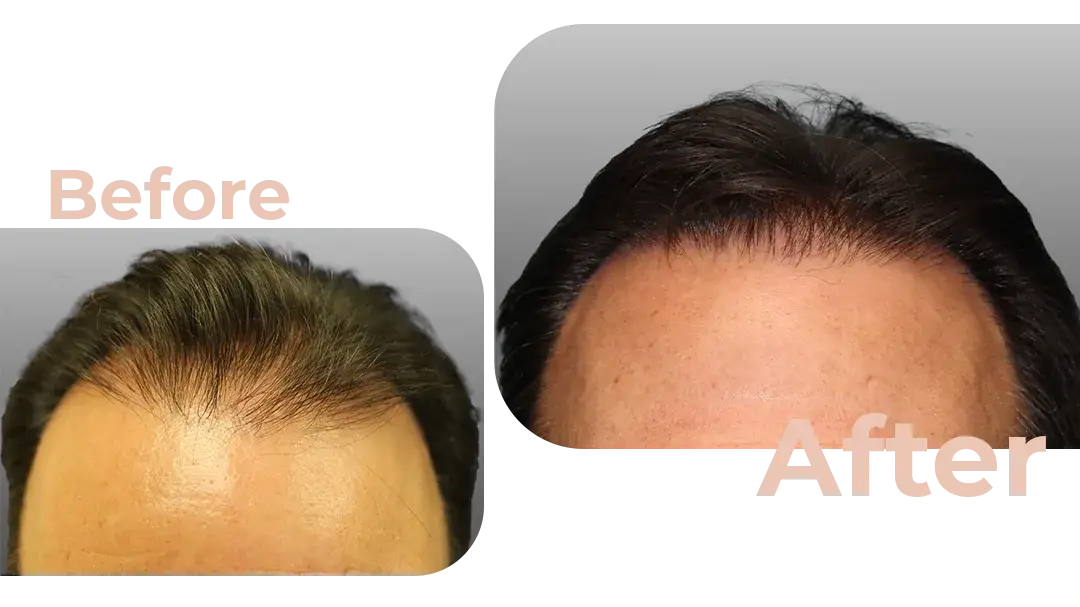 FUE Hair Transplant in Istanbul, Turkey by Avicenna Hospital