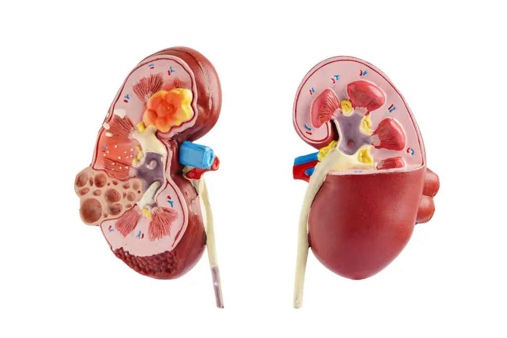 Kidney Cancer Treatment in Istanbul, Turkey by Avicenna Hospital — Oncology Procedure in Turkey
