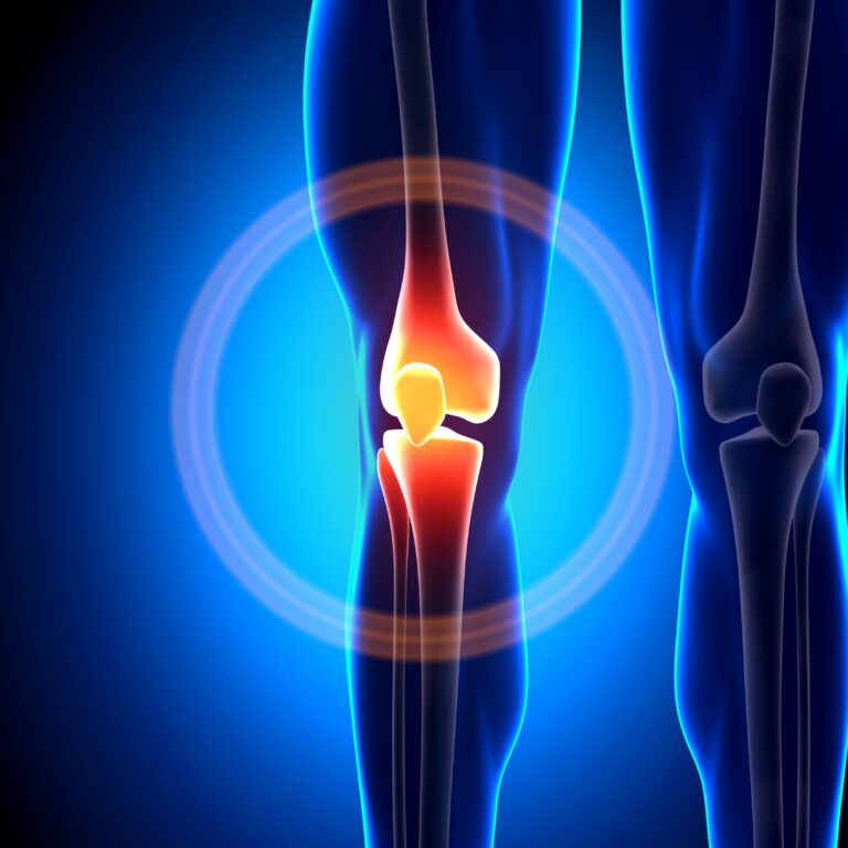 Knee Treatment with Stem Cells in Medellín, Colombia by StemCell Colombia