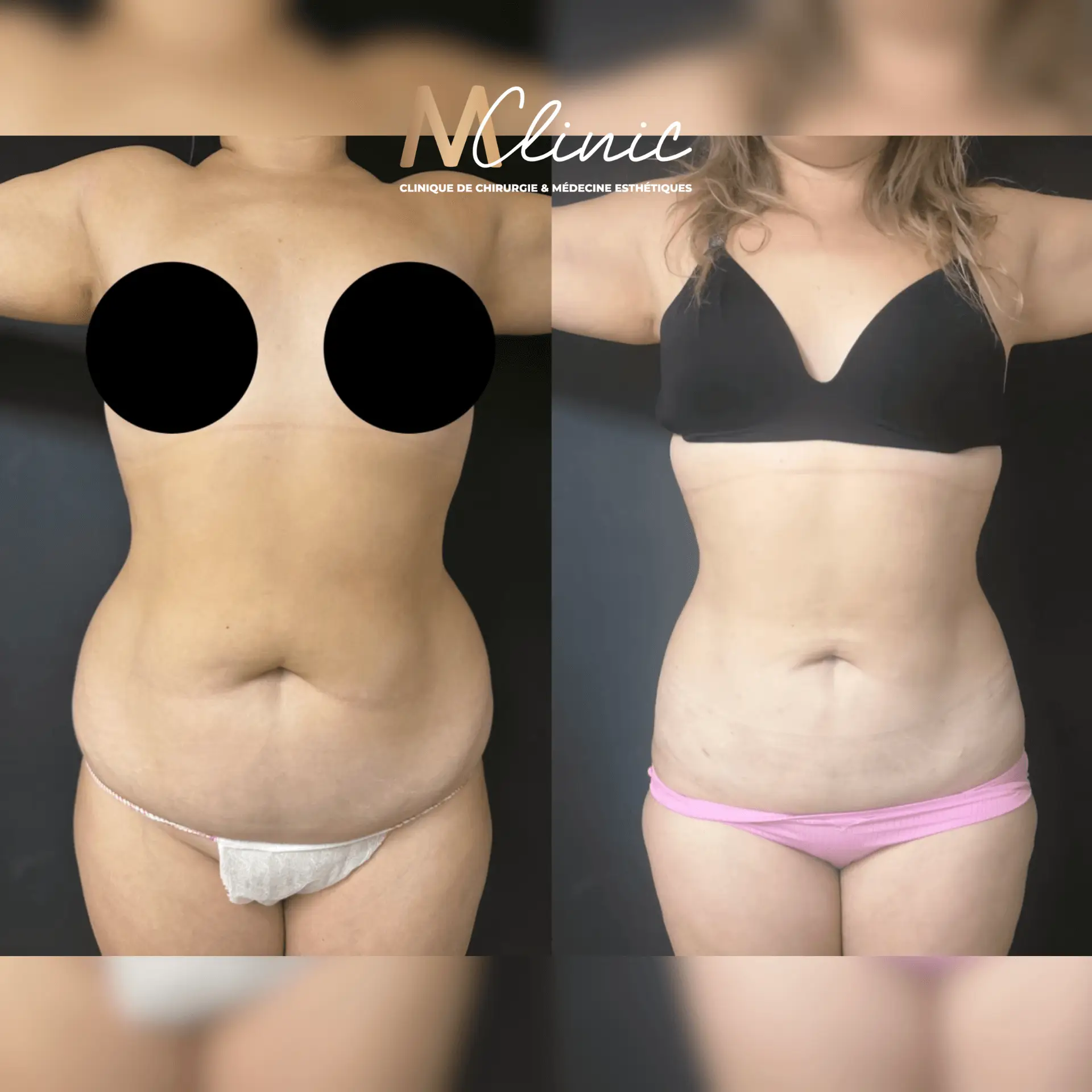 Liposuction for Arms, Thighs, Belly & Chin in Marrakech, Morocco by Mclinic Marrakesh