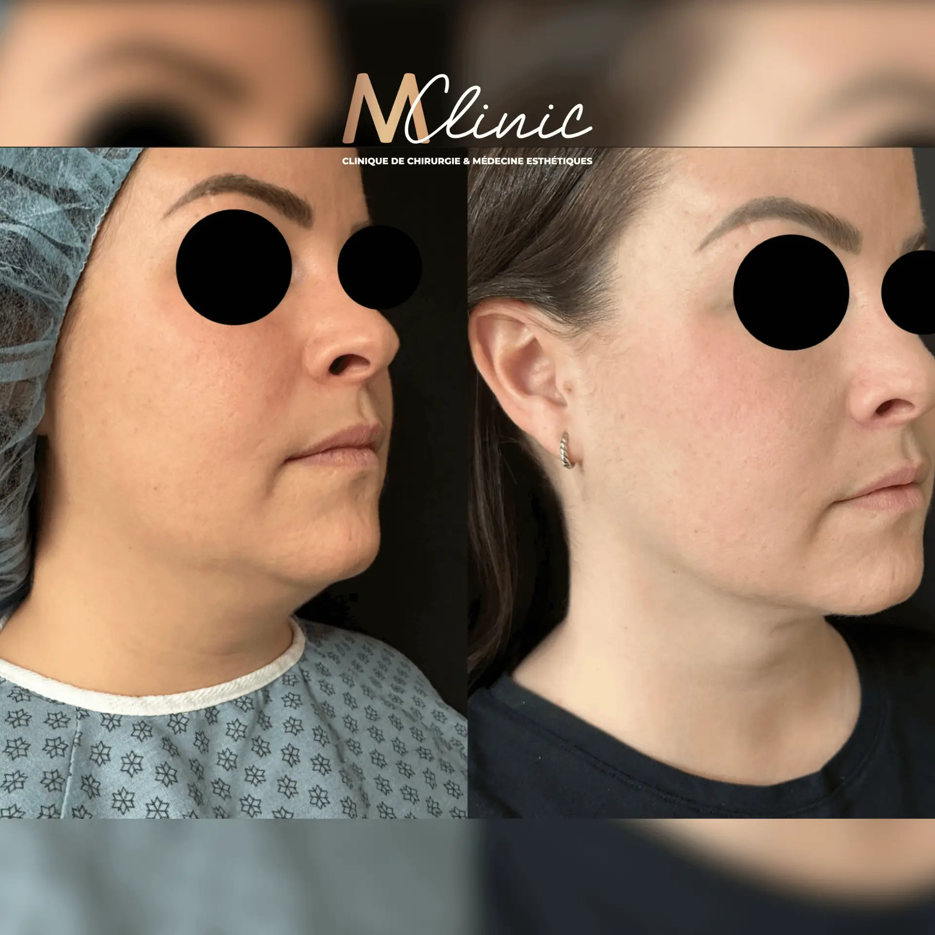 Liposuction for Arms, Thighs, Belly & Chin in Marrakech, Morocco by Mclinic Marrakesh
