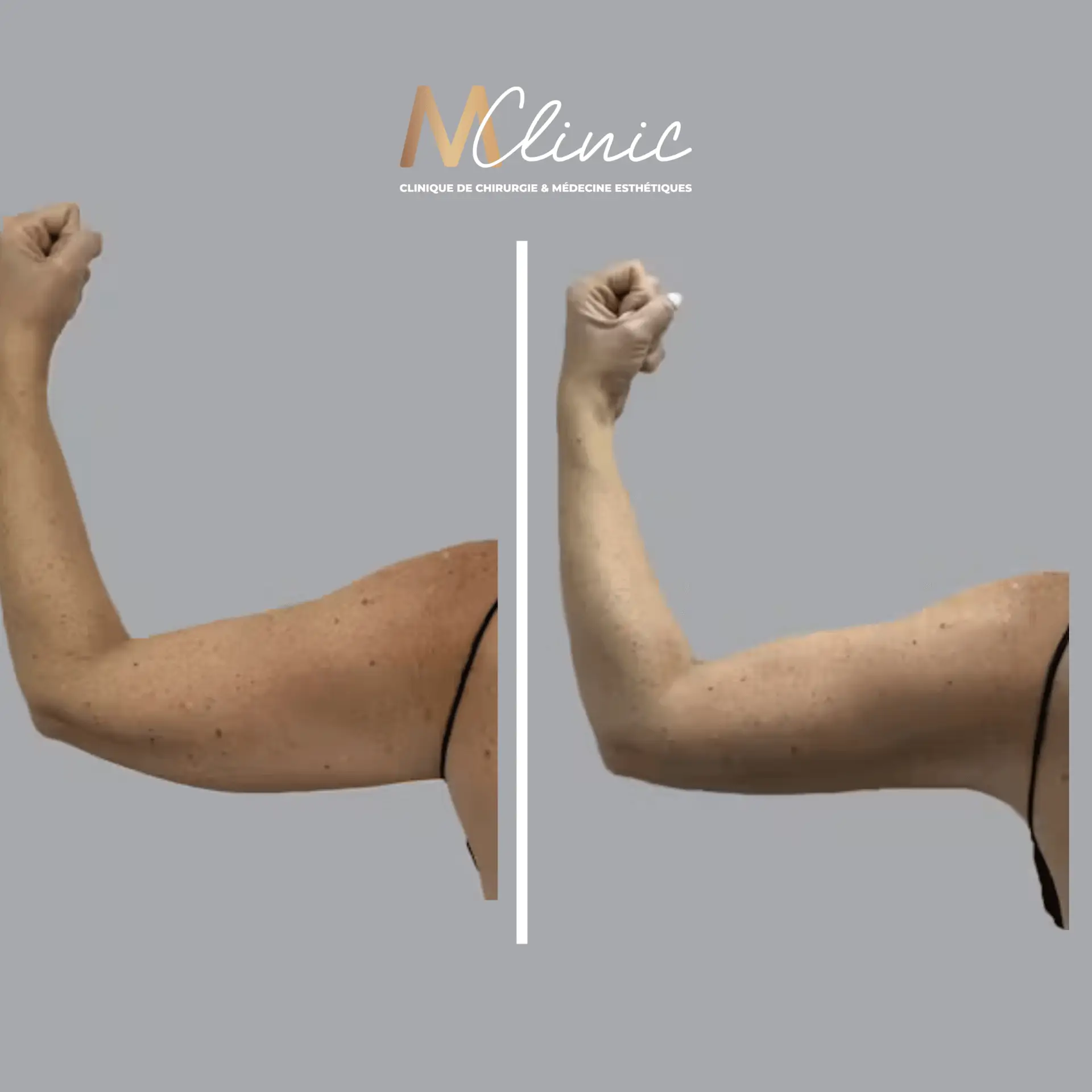 Liposuction for Arms, Thighs, Belly & Chin in Marrakech, Morocco by Mclinic Marrakesh