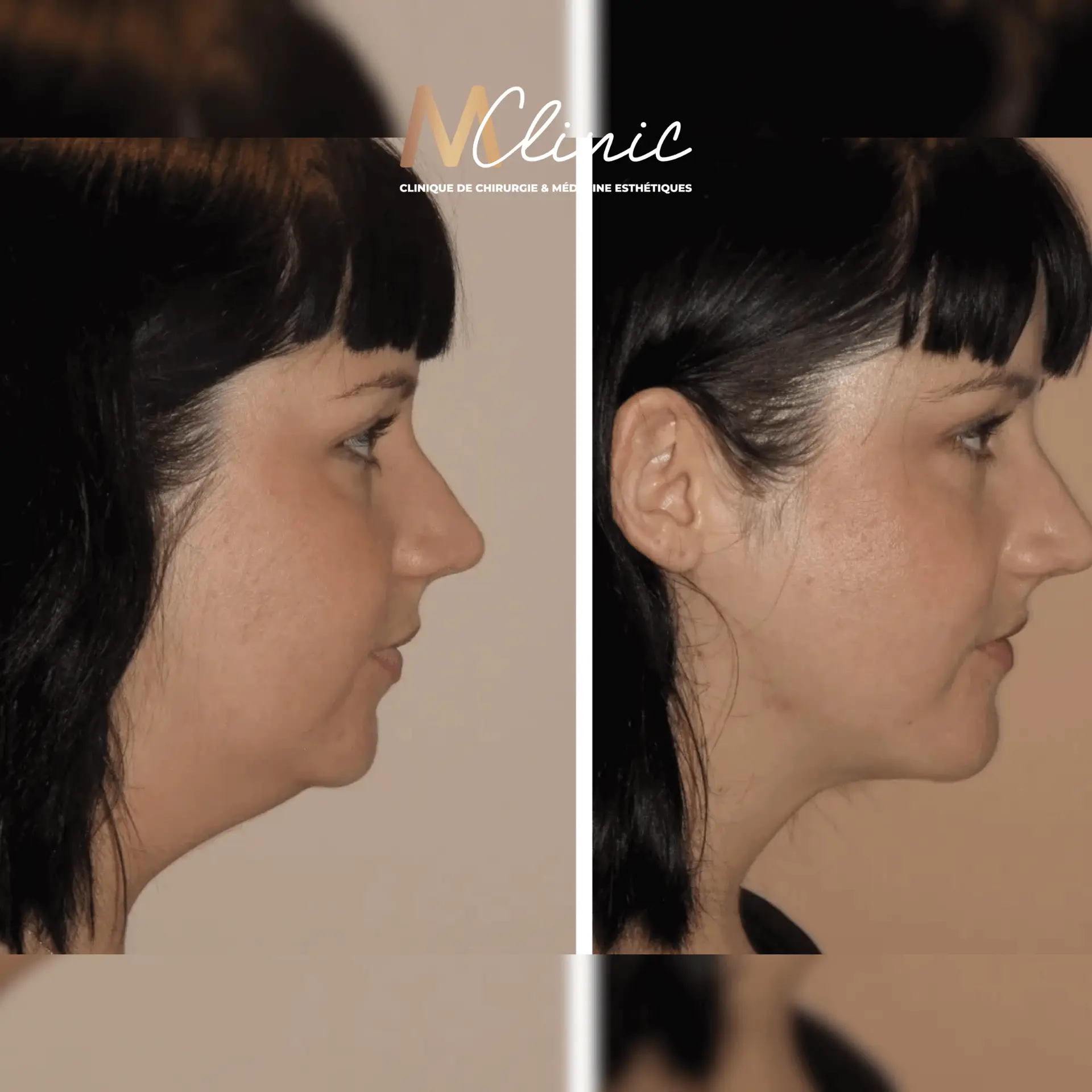 Liposuction for Arms, Thighs, Belly & Chin in Marrakech, Morocco by Mclinic Marrakesh