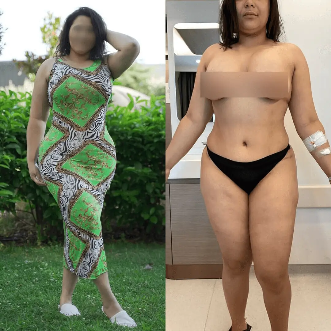 Liposuction for Arms, Thighs, Belly & Chin in Marrakech, Morocco by Mclinic Marrakesh