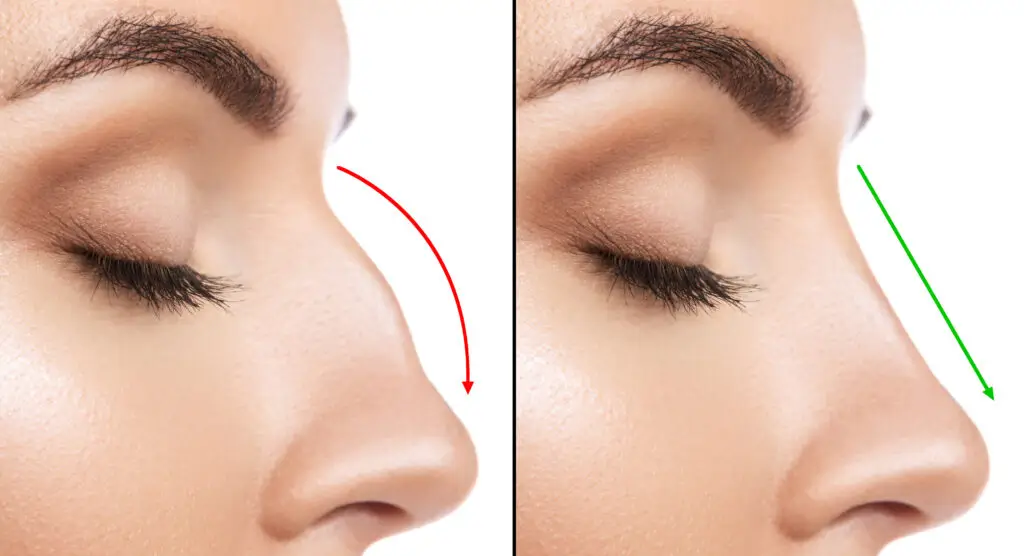 Rhinoplasty in Playa del Carmen, Mexico by CostaMed Medical Group — Plastic Surgery Procedure in Mexico