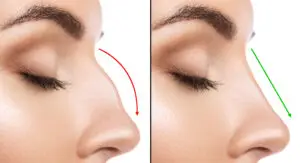Rhinoplasty in Playa del Carmen, Mexico by CostaMed Medical Group at CostaMed Medical Group — Plastic Surgery Procedure Abroad
