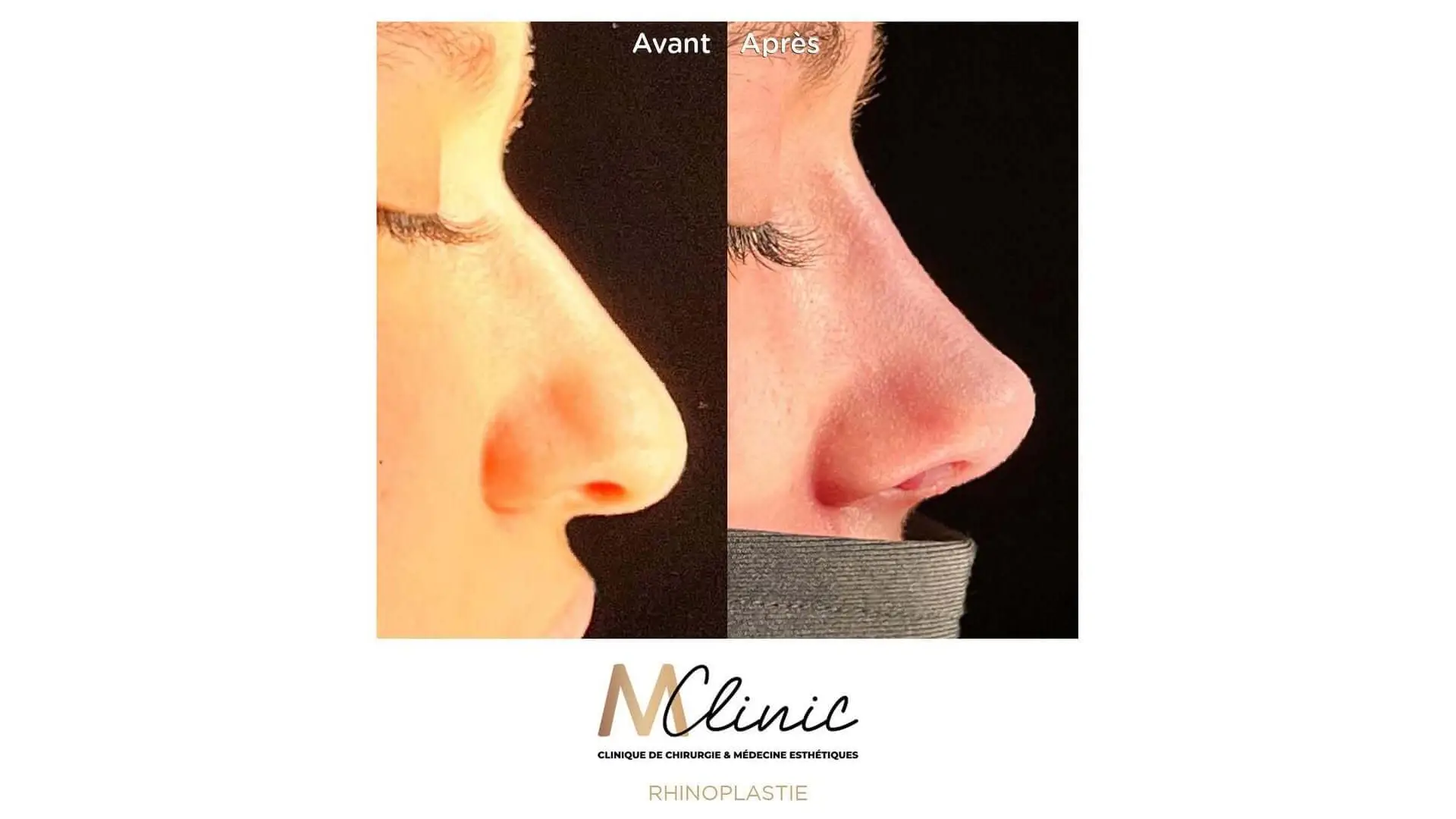 Rhinoplasty in Marrakech, Morocco by Mclinic Marrakesh