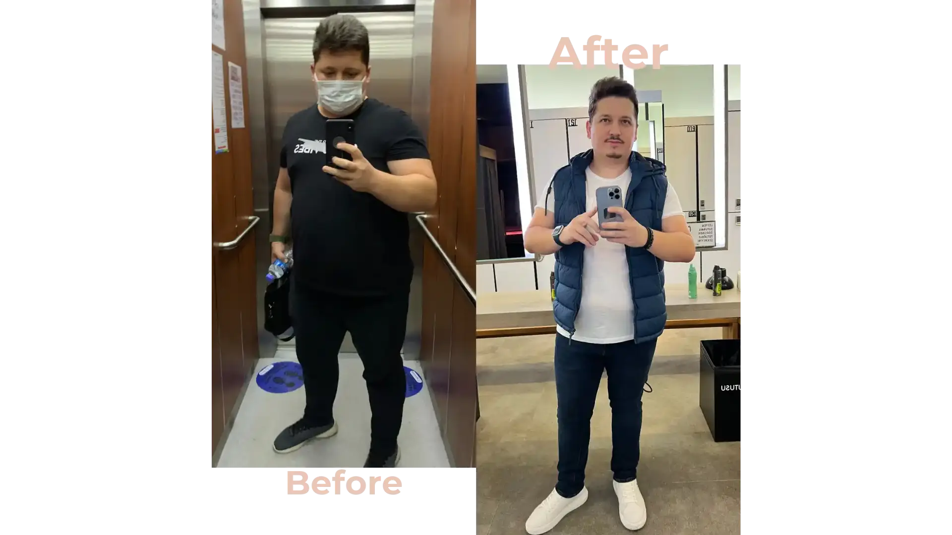 Gastric Bypass Surgery in Istanbul, Turkey by Avicenna Hospital