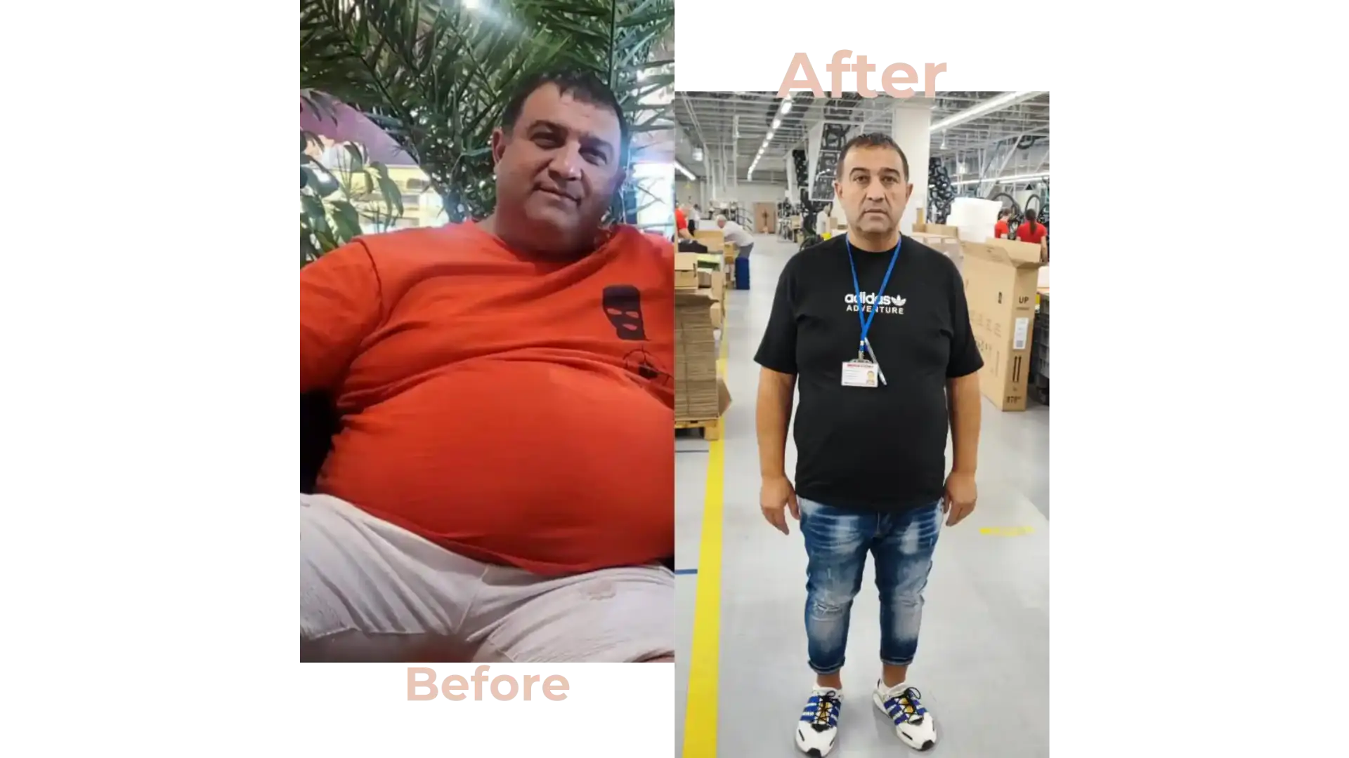 Gastric Bypass Surgery in Istanbul, Turkey by Avicenna Hospital