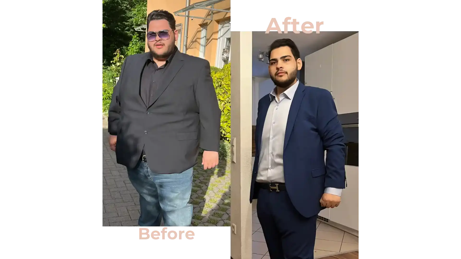 Gastric Bypass Surgery in Istanbul, Turkey by Avicenna Hospital