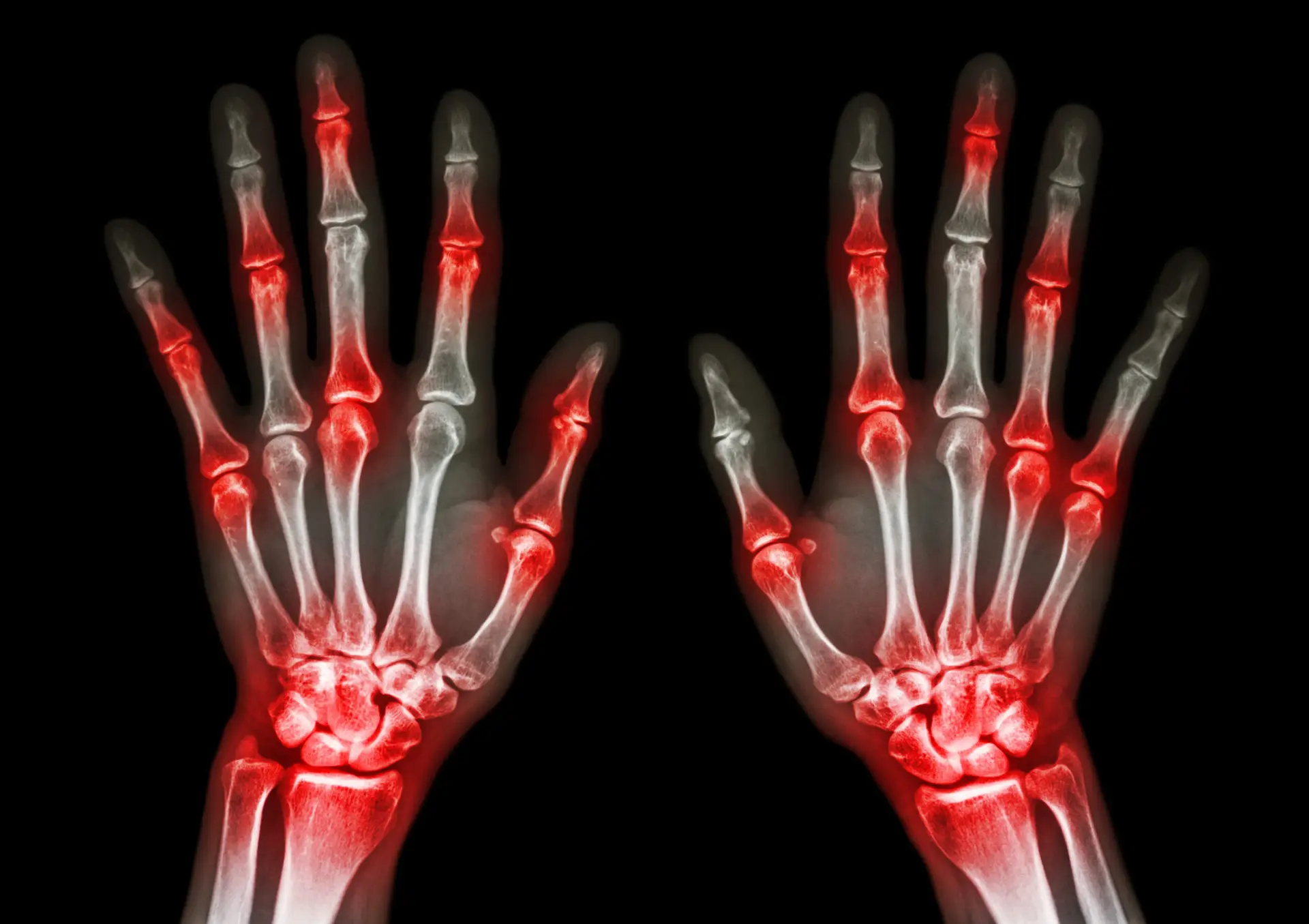 Arthritis Treatment with Stem Cells in Malacky, Slovakia by CellCenter Slovakia