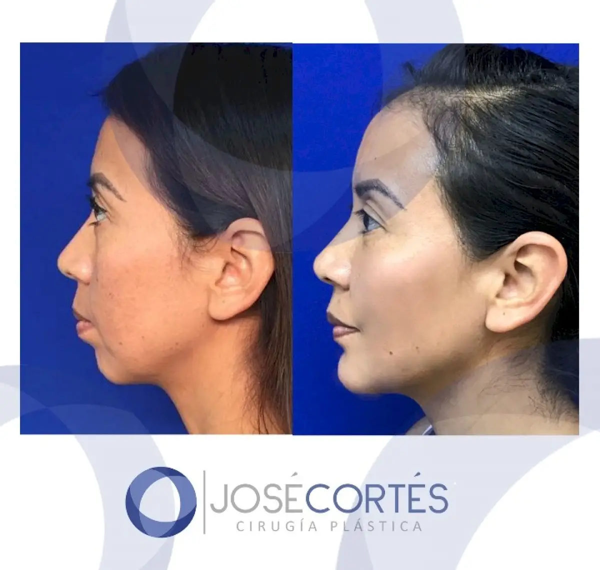Bichectomy in Mexico City, Mexico by Jose Cortes Institute