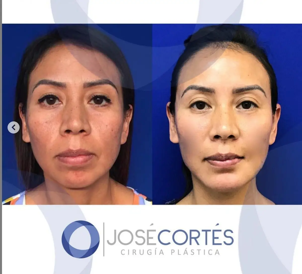 Bichectomy in Mexico City, Mexico by Jose Cortes Institute