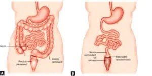 Colectomy Surgery in São Paulo, Brazil by Kaiser Clínica