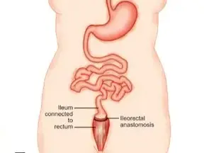 Colectomy Surgery in São Paulo, Brazil by Kaiser Clínica at Kaiser Hospital Dia — Oncology, Colorectal Surgery Procedure Abroad
