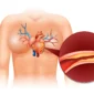 Coronary Angioplasty in Turkey Cost
