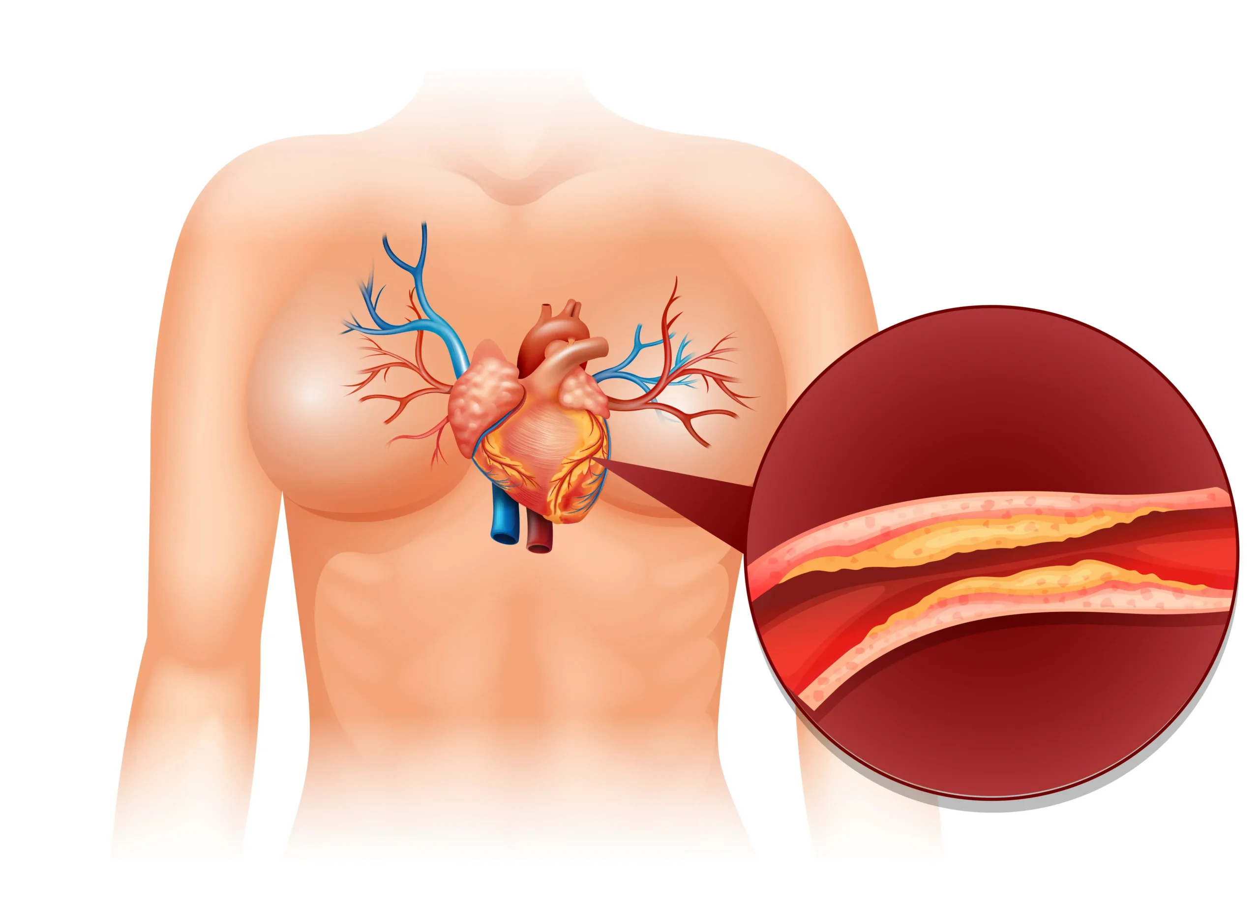 Coronary Angioplasty in Turkey Cost