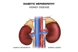 Diabetic Kidney Disease Clinics and Procedures Abroad