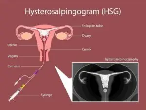 HSG Clinics and Procedures Abroad