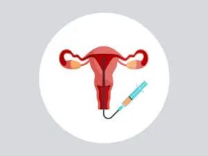 Intrauterine Insemination (IUI) Clinics and Procedures Abroad