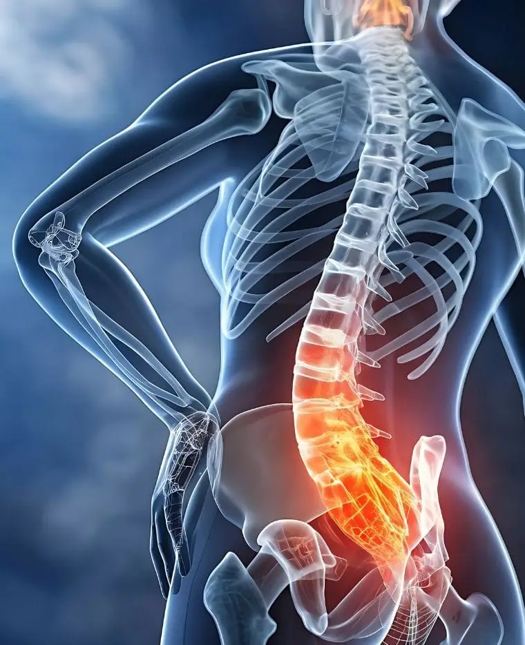 Lumbar pain (Back pain) Treatment with Stem Cells in Medellín, Colombia by StemCell Colombia