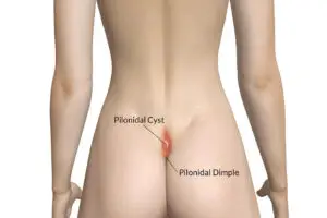 Pilonidal Cyst Surgery Clinics and Procedures Abroad