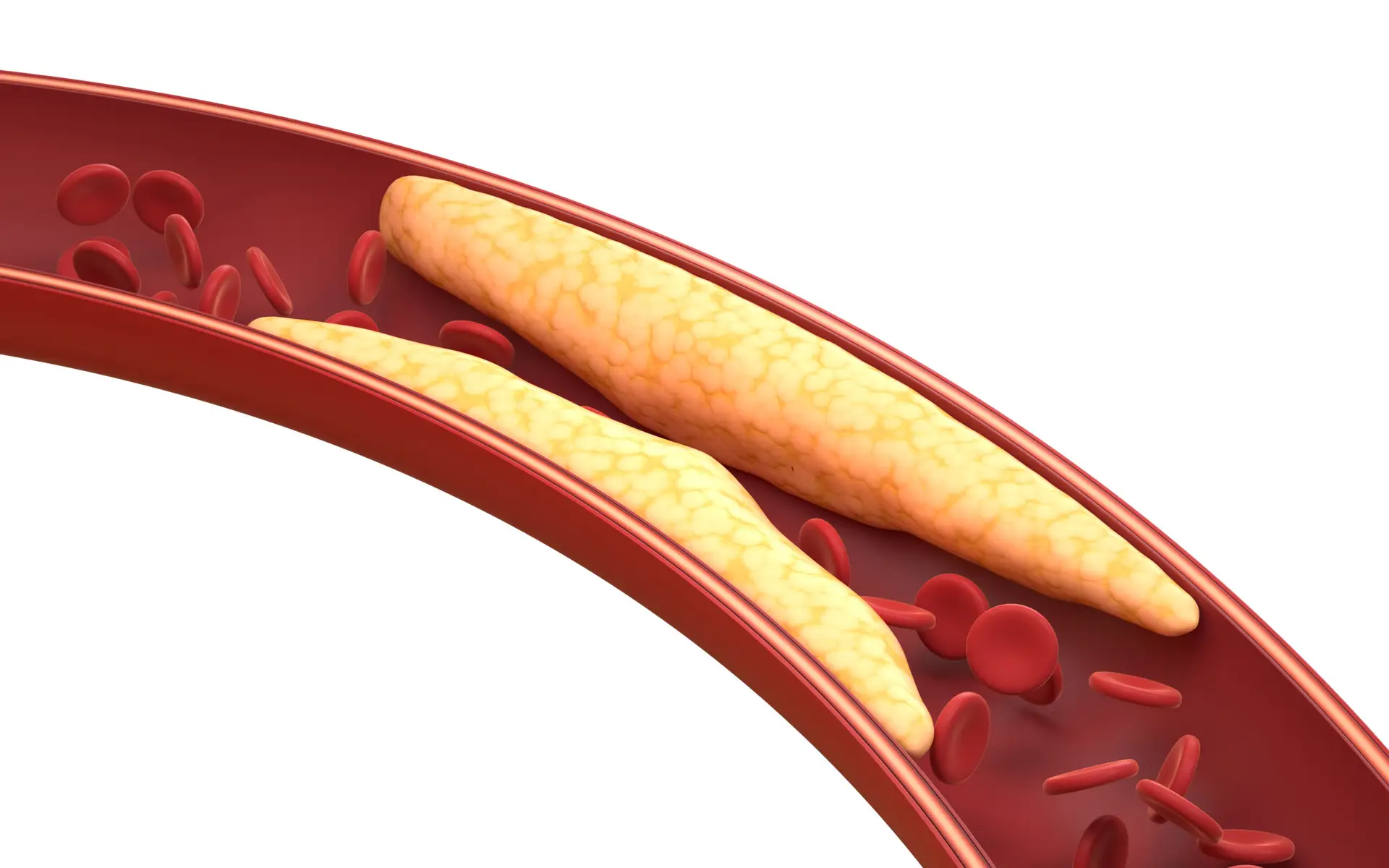 Coronary Angioplasty and Stenting in Panama City, Panama by Pacifica Salud — Procedure Gallery Photo