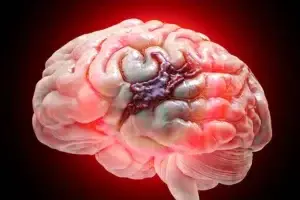 Brain Hemorrhage Treatment Clinics and Procedures Abroad