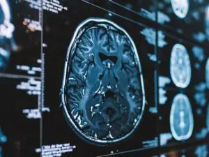 Brain Haemorrhages Treatment in Istanbul, Turkey by Avicenna Hospital — Neurology in Turkey