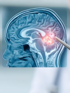 Brain Tumor Surgery in Panama City, Panama by Pacifica Salud at Pacifica Salud — Oncology Procedure Abroad